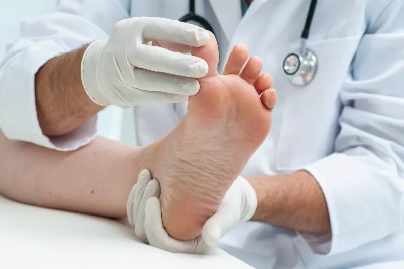 FURCSA ALAKÚ LÁBFEJ, KALAPÁCSUJJ. A károsodott idegi funkciók nagy hatást gyakorolnak a járásra, és ez bizony a lábfej alakját is befolyásolhatja, mivel máshová rakódhat a súlypont. Éppen ezért szokatlan változásokat tapasztalhat a beteg a láb boltozatában. Az egyik leggyakoribb deformálódás a kalapácsujj, amikor az egyik lábujj (a nagy lábujjat kivéve) eldeformálódik.