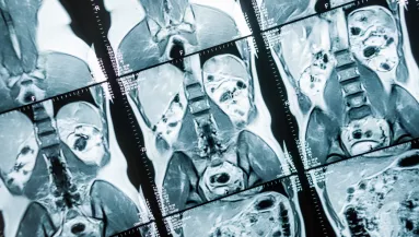 Egy hatalmas daganatot akarnak eltávolítani a nő hasából: amit találnak, az orvosokat is sokkolja – Fotók